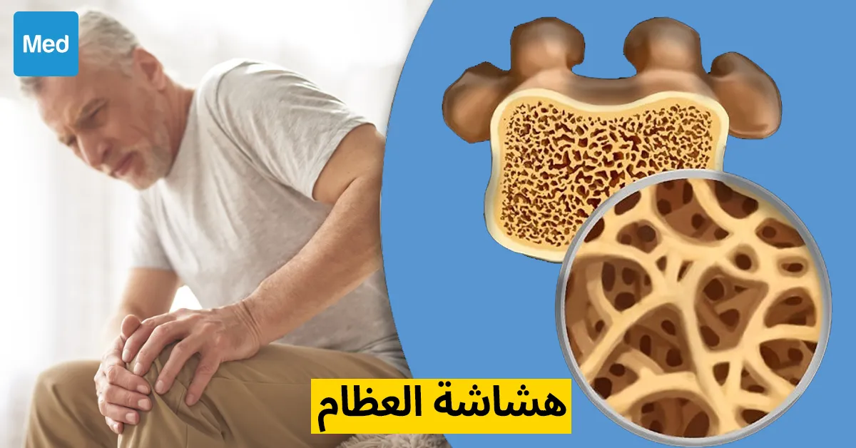 هشاشة العظام : فهم وعلاج هذا المرض الصامت